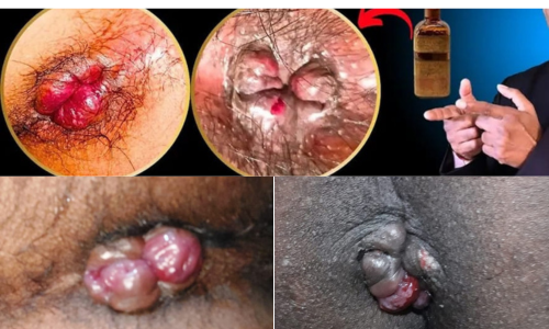 Best Piles Fistula Treatment