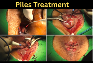 Piles Treatment in Bangladesh