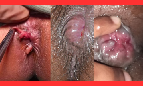 Piles রোগের লক্ষণ কী কী