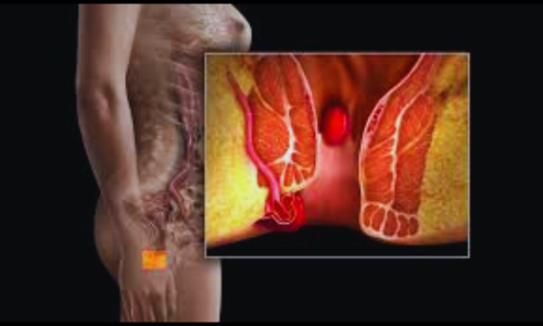 Best Piles Treatment Doctor Foridul Islam