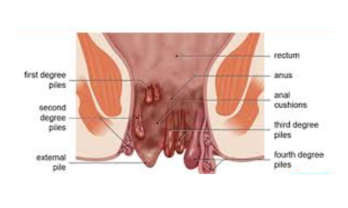 Piles Treatment