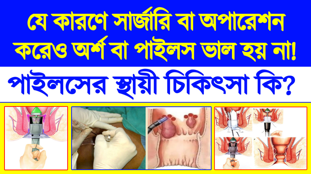 পাইলস স্থায়ীভাবে সারানোর উপায়