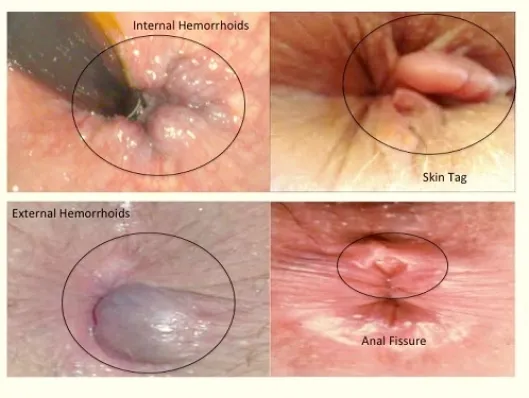 Piles Symptoms